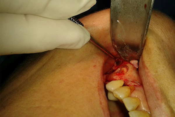 Clínica Dental Dr. Presencia Martí persona extrayendo diente
