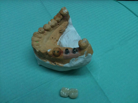 Clínica Dental Dr. Presencia Martí molde dental